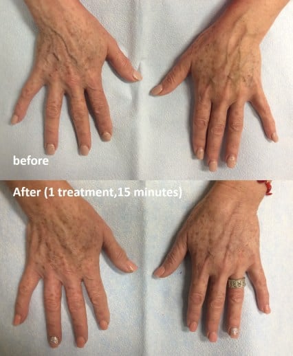 Before and After // East Bay Vein Specialists
