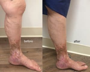 5 Tips To Prevent Varicose Veins and Varicose Ulcers - By Dr