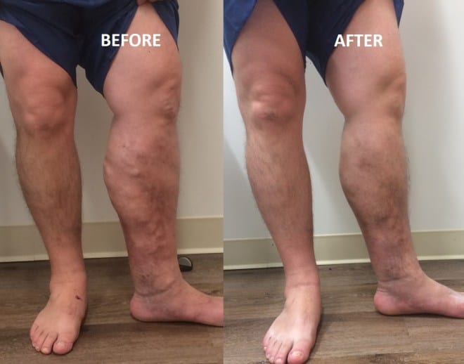 Tracy Varicose Vein Treatment // East Bay Vein Specialists