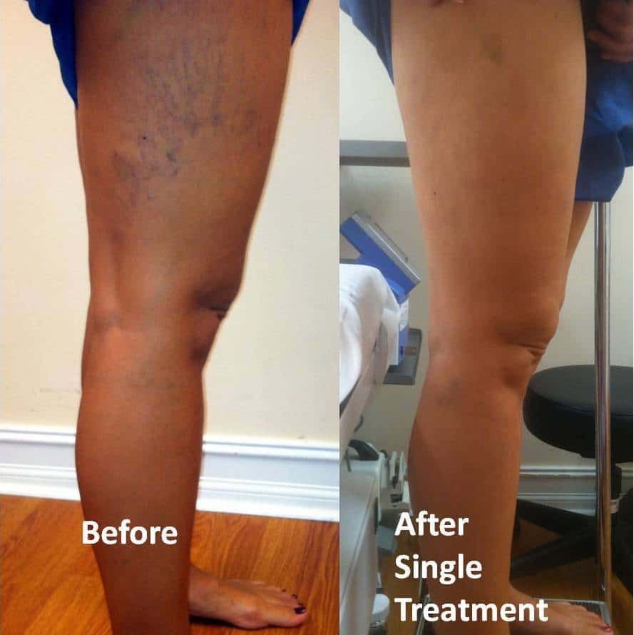Spider Veins - What are they and how do I get them treated? - Vein