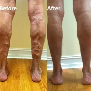 60+ year old man after single laser varicose vein treatment on each leg.