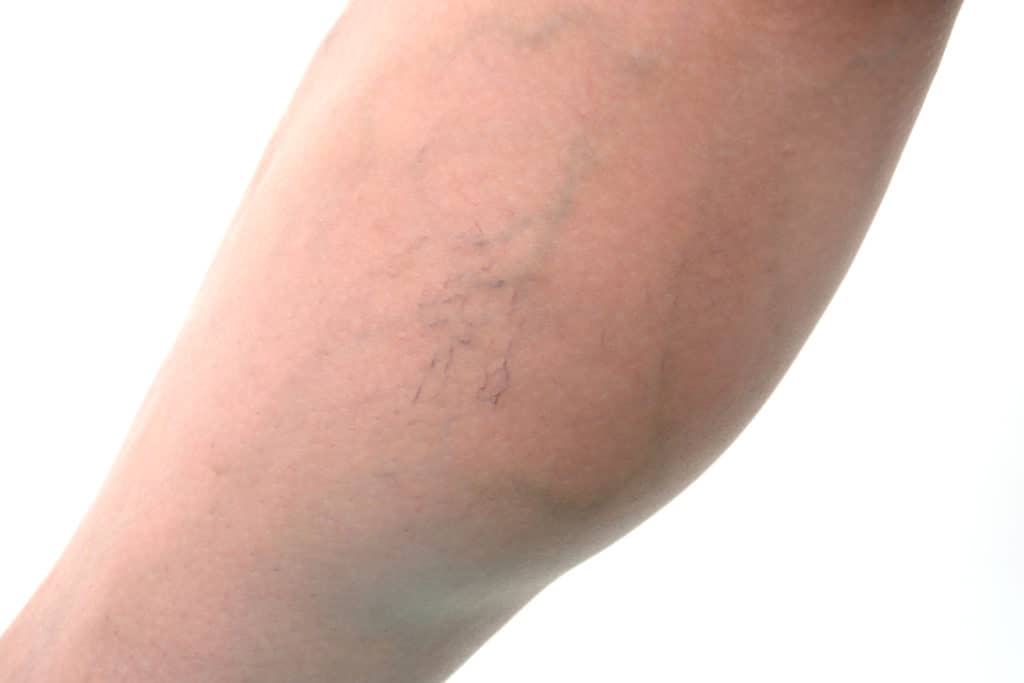 varicose veins prevention and treatment options provided by East Bay Vein Specialists