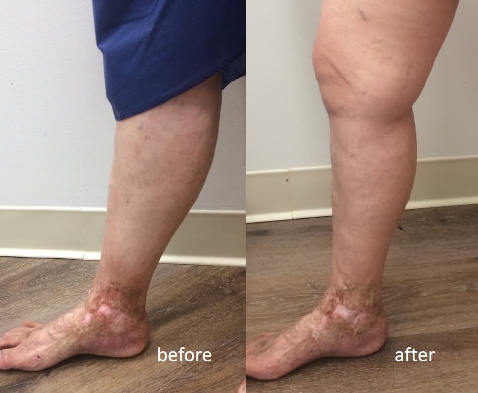 Venous Ulcers Treatment At East Bay Vein Specialists