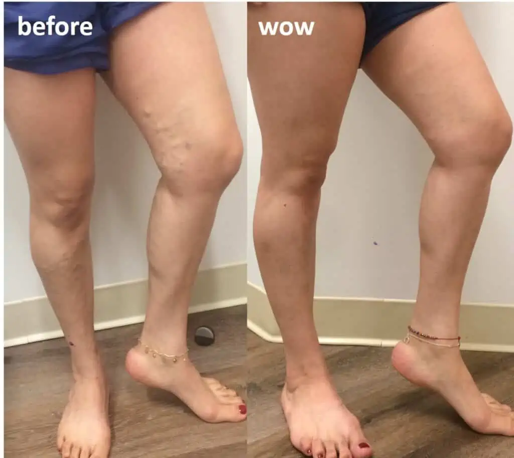 Varicose Vein Before and After Treatment Pictures - Get Treatment for Vein Issues at East Bay Vein Specialists
